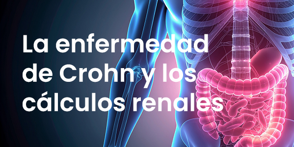 La enfermedad de Crohn y los cálculos renales